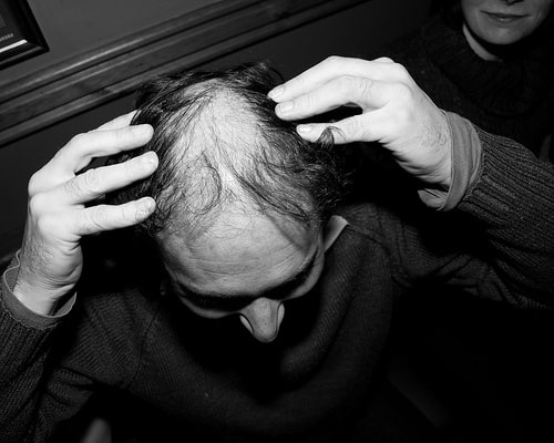 Where's my hair gone? Pic by: The Triangle, Lowestoft