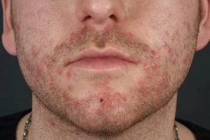 Ingrown Vs. Folliculitis: Understand The Difference