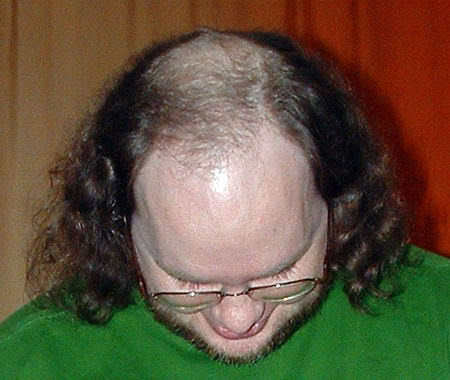 Male baldness. 