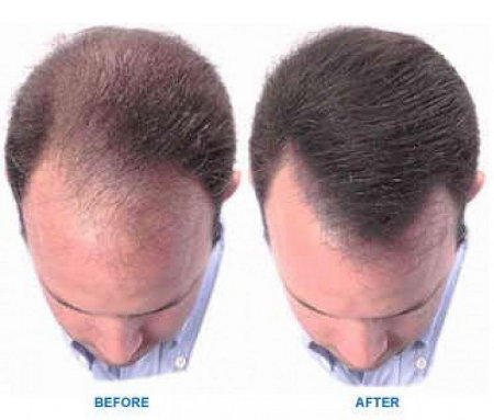 can you use rogaine without hair loss