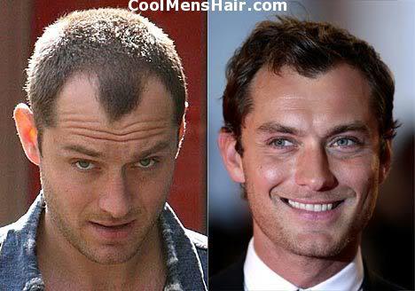 Celebrity Hair Transplants Before And After  Wimpole Clinic